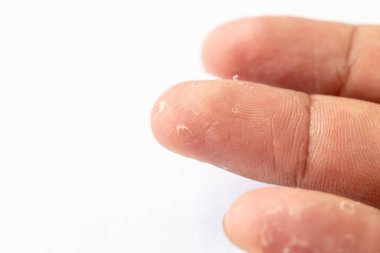 İnsan vücudunda egzama ve mantar hastalıklarının seyri.