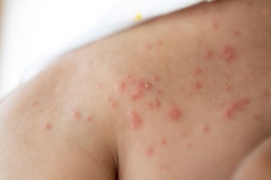 Pattern of Atopic eczema and fungal diseases on the human body.