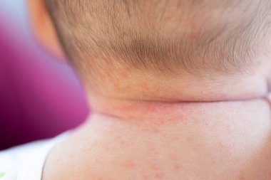 Pattern of Atopic eczema and fungal diseases on the human body.