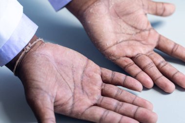 İnsan vücudunda egzama ve mantar hastalıklarının seyri.