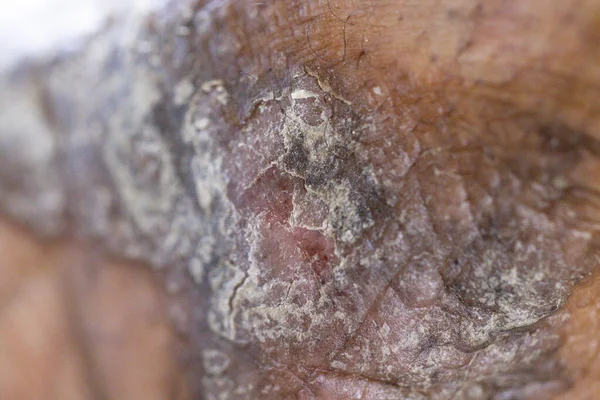 Pattern Atopic Eczema Fungal Diseases Human Body — Fotografia de Stock