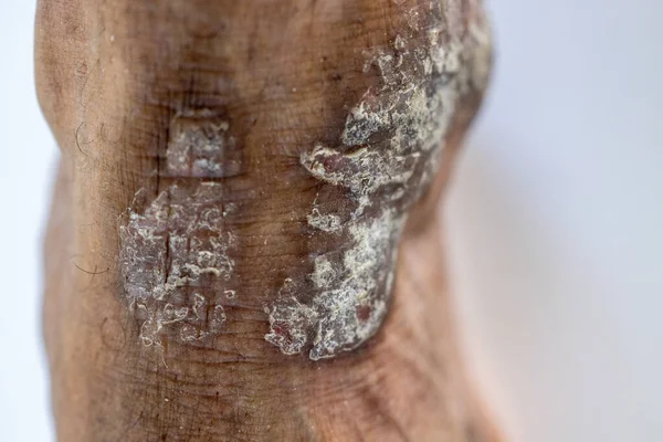 Pattern Atopic Eczema Fungal Diseases Human Body — ストック写真
