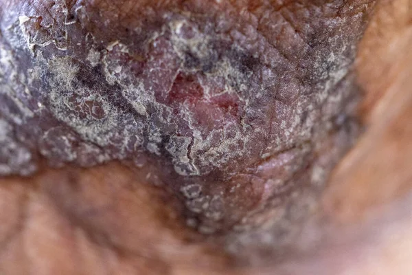 Pattern Atopic Eczema Fungal Diseases Human Body — Fotografia de Stock