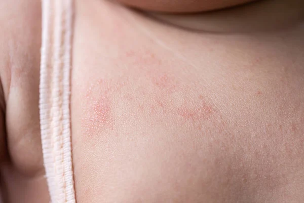 Pattern Atopic Eczema Fungal Diseases Human Body — Stock Photo, Image