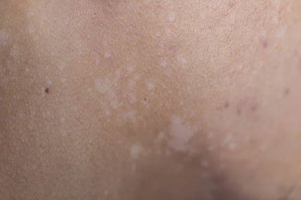 Pattern Atopic Eczema Fungal Diseases Human Body — Stock Photo, Image