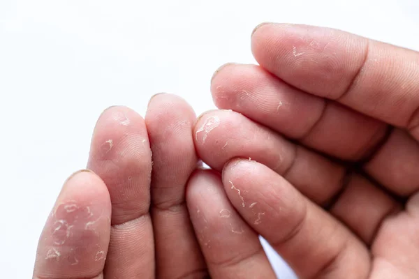 Padrão Eczema Atópico Doenças Fúngicas Corpo Humano — Fotografia de Stock
