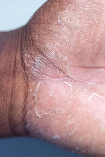 Padrão Eczema Atópico Doenças Fúngicas Corpo Humano — Fotografia de Stock