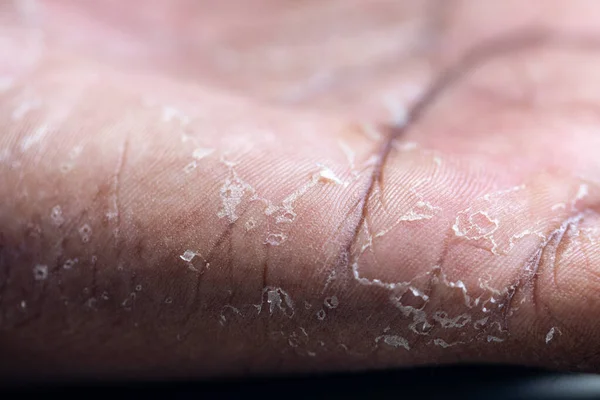 Pattern Atopic Eczema Fungal Diseases Human Body — Fotografia de Stock