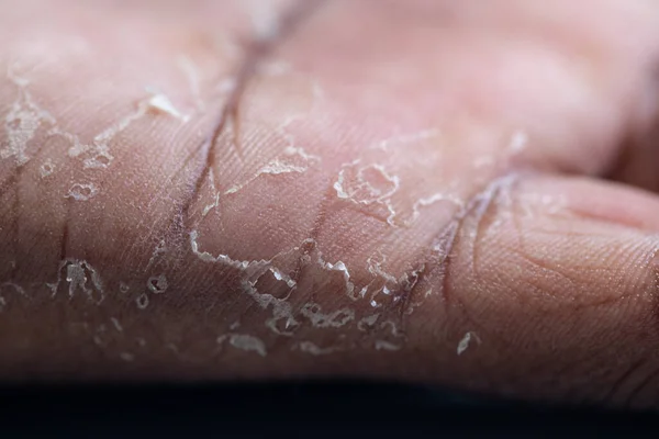 Pattern Atopic Eczema Fungal Diseases Human Body — Fotografia de Stock