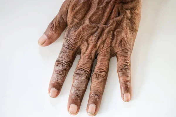 Візерунок Атопічної Екземи Грибкових Захворювань Організм Людини — стокове фото