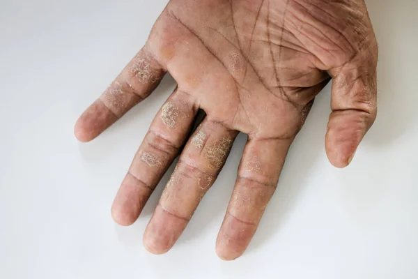 Pattern of Atopic eczema and fungal diseases on the human body.