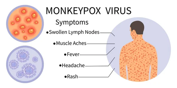 猴痘病毒横幅症状感知 猴痘病毒的症状在信息图上 有皮疹的人体 该疾病的症状 游泳淋巴结 肌肉痉挛 — 图库矢量图片