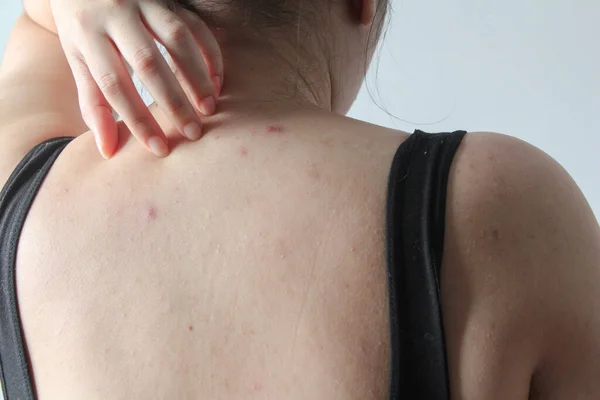 Mujer Joven Mostrando Espalda Con Manchas Acné Cicatriz Roja — Foto de Stock