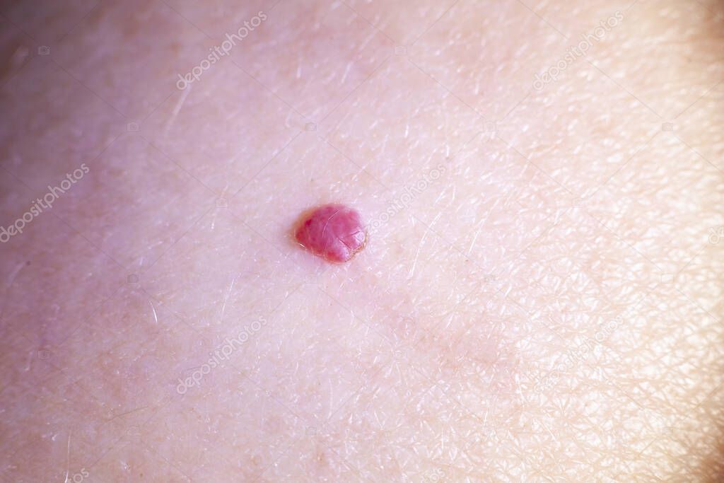 a large red mole on human skin. macro