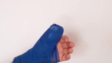 Bandajlı el. Kolunda beyaz bir arka planda mavi cerrahi bandaj var. Kırık kol. Kırıklar ve burkulmalar. Bandajlar ve bandajlar..
