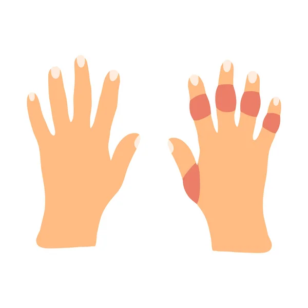 Mani con artrite reumatoide malattia in stile cartone animato piatto. Illustrazione vettoriale di rigidità malata articolazioni gonfie. Disturbi umani — Vettoriale Stock