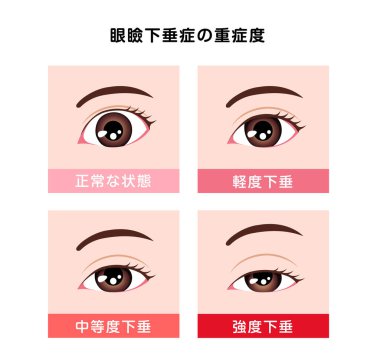 Ptosis vektör çiziminde derecelendirme