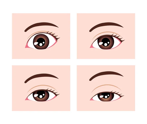 Indeling Ptosis Vector Illustratie — Stockvector