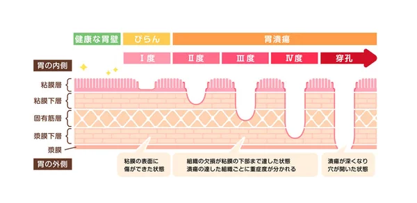 胃溃疡 胃溃疡 病媒图例 — 图库矢量图片