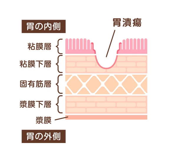 胃溃疡的病灶图解 — 图库矢量图片