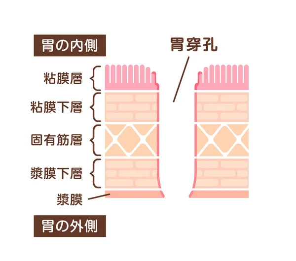 穿孔溃疡的切面图 — 图库矢量图片