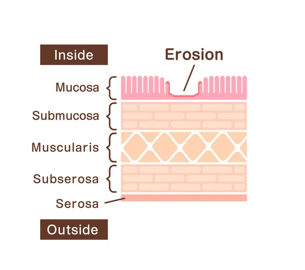 Sektionsvy Illustration Gastrisk Erosion — Stock vektor