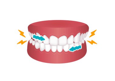 Bruxism vector illustration | grinding teeth clipart