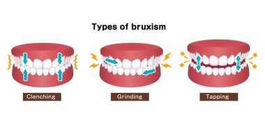 Types of bruxism (teeth grinding) vector illustration clipart
