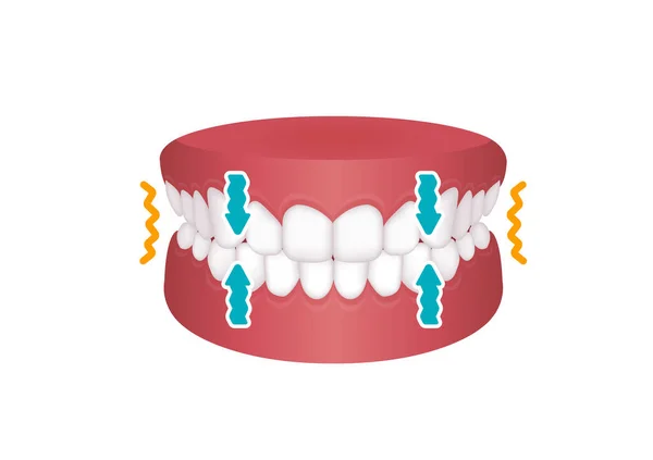 Illustration Vectorielle Bruxiste Dents Serrées — Image vectorielle