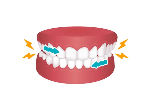 Bruxism Διανυσματική Απεικόνιση Λείανση Δοντιών — Διανυσματικό Αρχείο