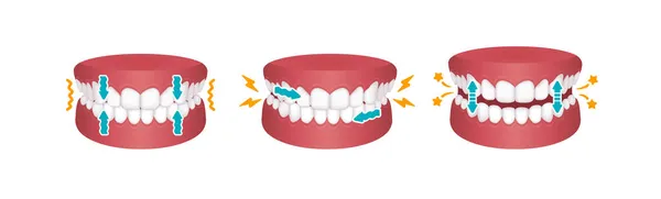 Typy Bruxismu Broušení Zubů Vektorové Ilustrace — Stockový vektor