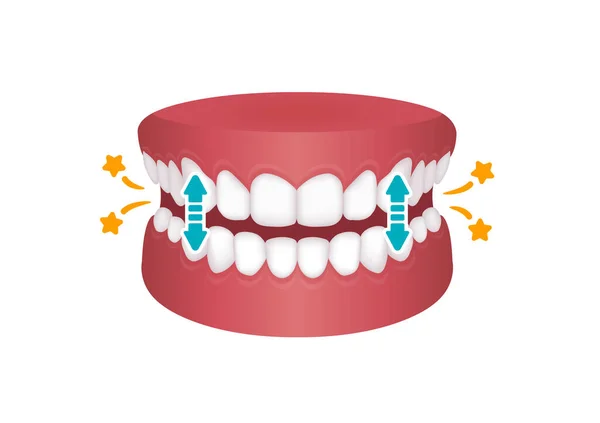 Bruxismo Vetor Ilustração Cortando Dentes —  Vetores de Stock