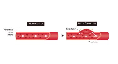 Normal aortun ve aort diseksiyonunun karşılaştırılması 