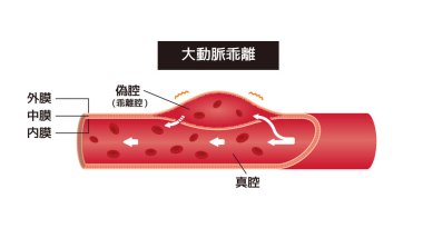 Aort diseksiyonunun vektör çizimi (Japonca)