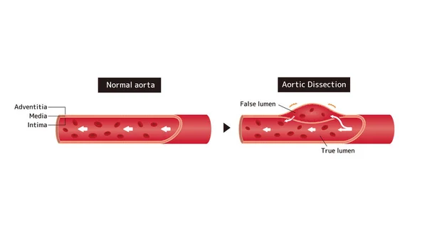 Confronto Illustrazione Della Normale Aorta Dissezione Aortica — Vettoriale Stock