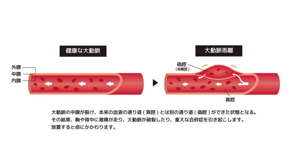 大動脈と大動脈の比較図 日本語 — ストックベクタ