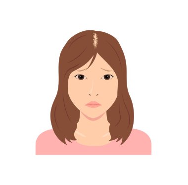 Dişi Androgenetik Alopecia vektör çizimi