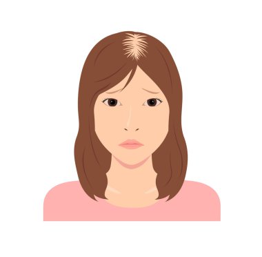 Dişi Androgenetik Alopecia vektör çizimi