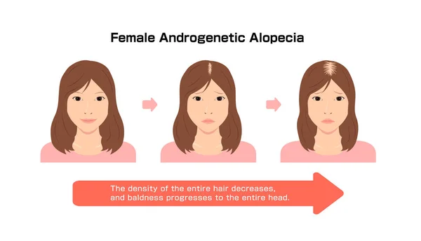 Progress Female Androgenetic Alopecia Vector Illustration — Vetor de Stock