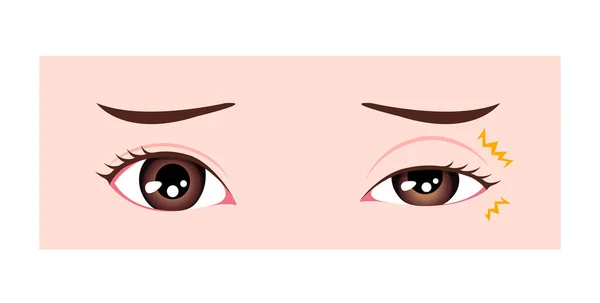 Causes Myokymia Eyelid Twitch Tic Vector Illustration — Vettoriale Stock