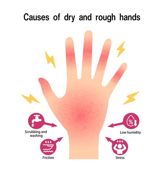 Causes Dry Rough Hands Chapped Hands Vector Illustration — Stockvektor