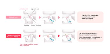 Normal çene ve Temporomandibular bozuklukların karşılaştırılması (TMD)