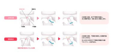Normal çene ve Temporomandibular bozuklukların karşılaştırılması (TMD)