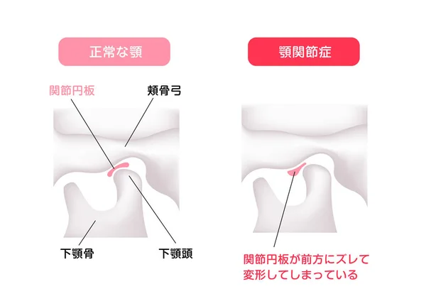 Illustration Comparing Shapes Articular Disk Normal Jaw Temporomandibular Disorders — Stock Vector