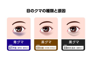 Gözlerinin altındaki siyah halkaların türleri ve nedenleri. Vektör illüstrasyonu (Japonca)