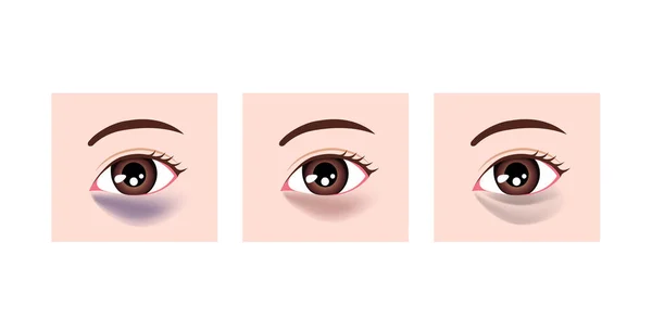 Farbtypen Von Augenringen Vektorillustration — Stockvektor