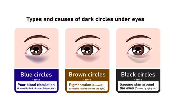 Gözlerinin Altındaki Siyah Halkaların Türleri Nedenleri Vektör Illüstrasyonu — Stok Vektör