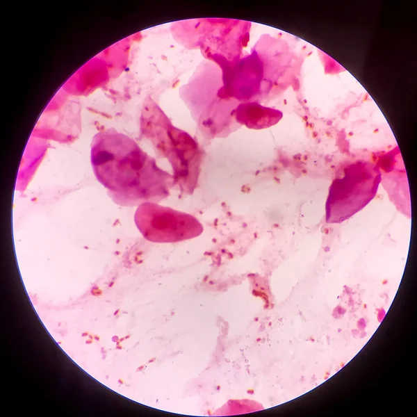 赤血球細胞カプセル病原体を有するグラム陰性菌グラム染色法におけるスプツムの例 — ストック写真