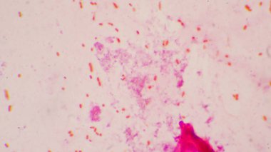 Alyuvar hücreleri Gram negatif bakterili kapsül patojenli bakteri. Gram boyama metodunda örnek balgam.