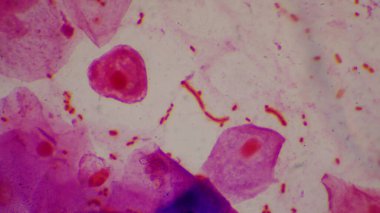 Alyuvar hücreleri Gram negatif bakterili kapsül patojenli bakteri. Gram boyama metodunda örnek balgam.